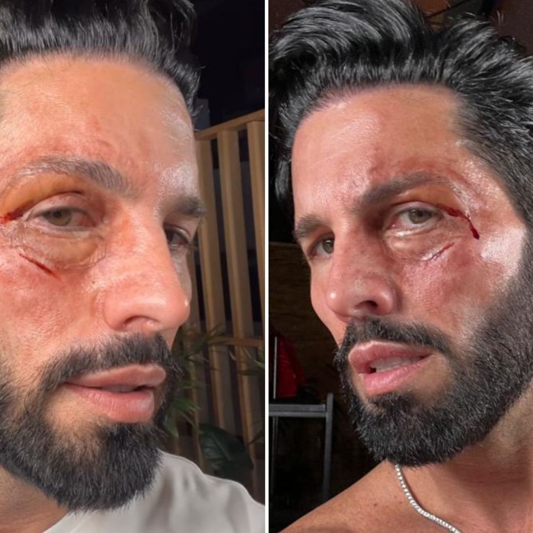 Poncho de Nigris preocupó a sus seguidores al compartir una foto con la cara golpeada; esto fue lo que le pasó