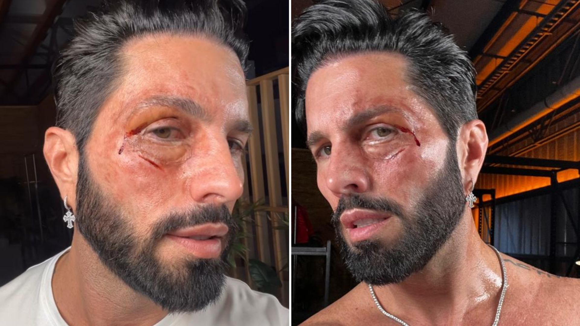 Poncho de Nigris preocupó a sus seguidores al compartir una foto con la cara golpeada; esto fue lo que le pasó