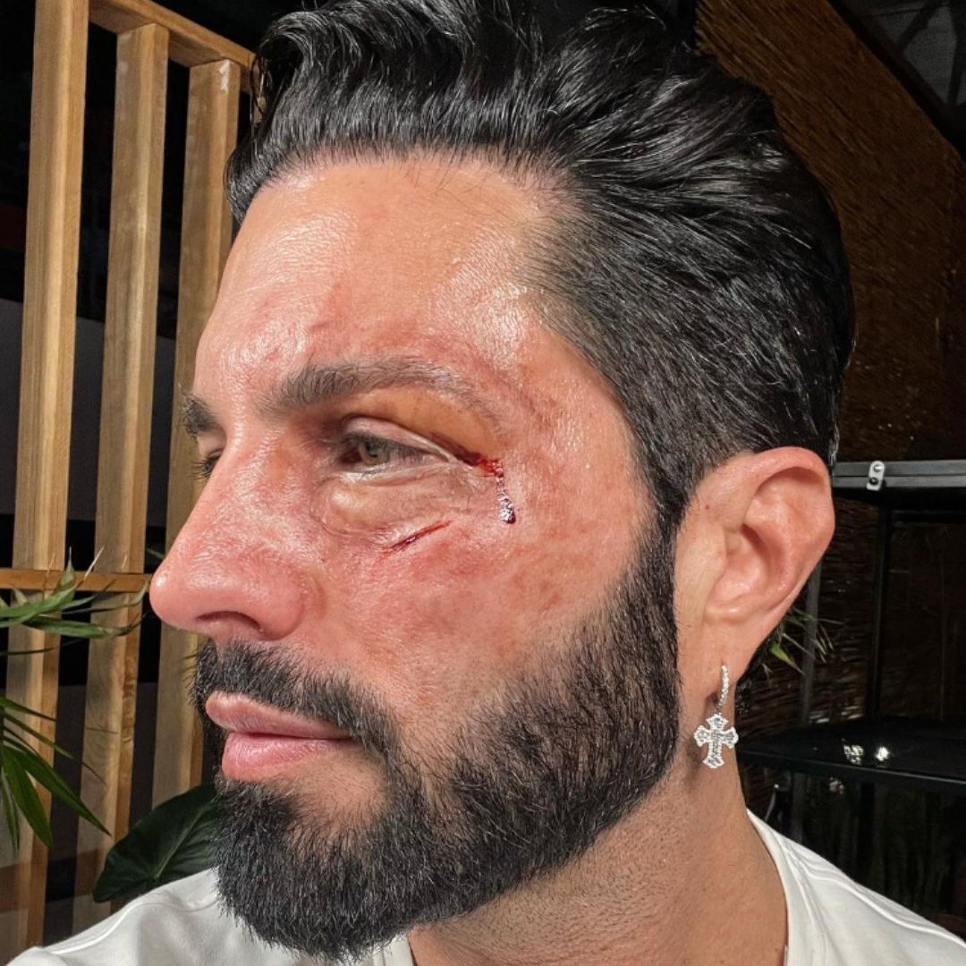 Poncho De Nigris Difunde Foto de Su Rostro Golpeado