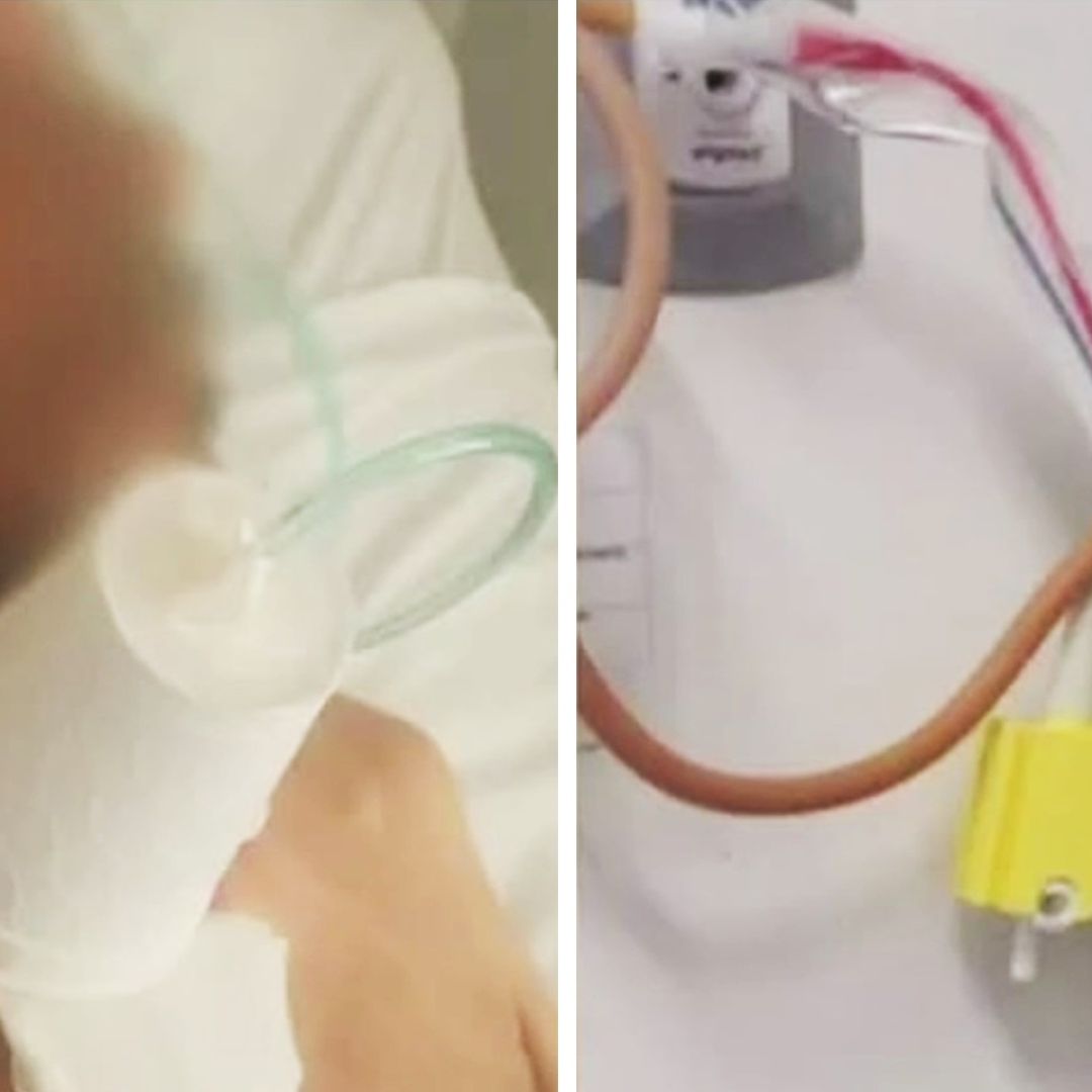 Hospital General de Gómez Palacio: Médicos Improvisan Mascarilla de Oxígeno con Vaso de Unicel