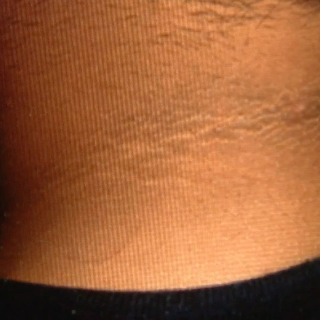 La Acantosis Nigricans, se le suele confundir con falta de higiene o quemadura por el sol.