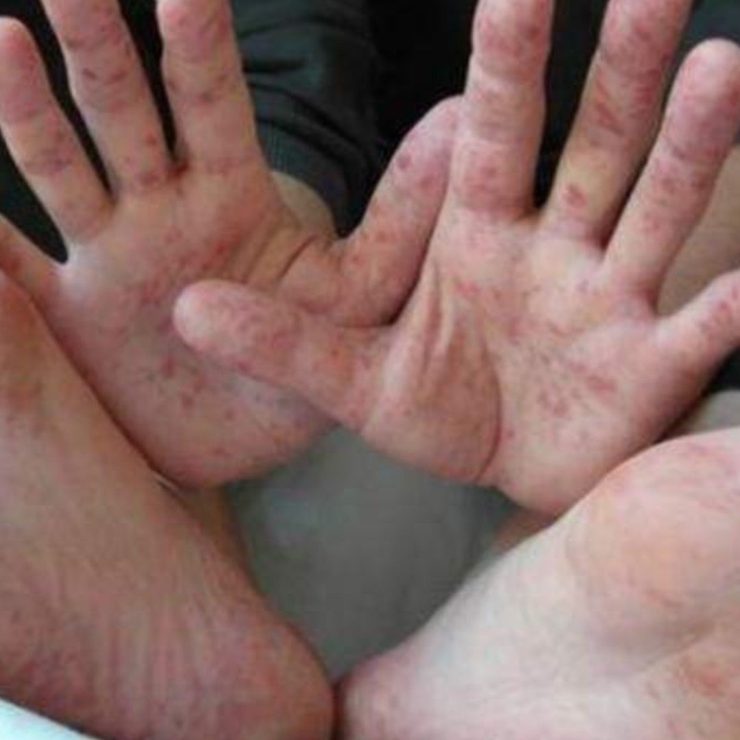 Brote del Virus Coxsackie en Puebla 7 Casos Confirmados en Menores de Edad