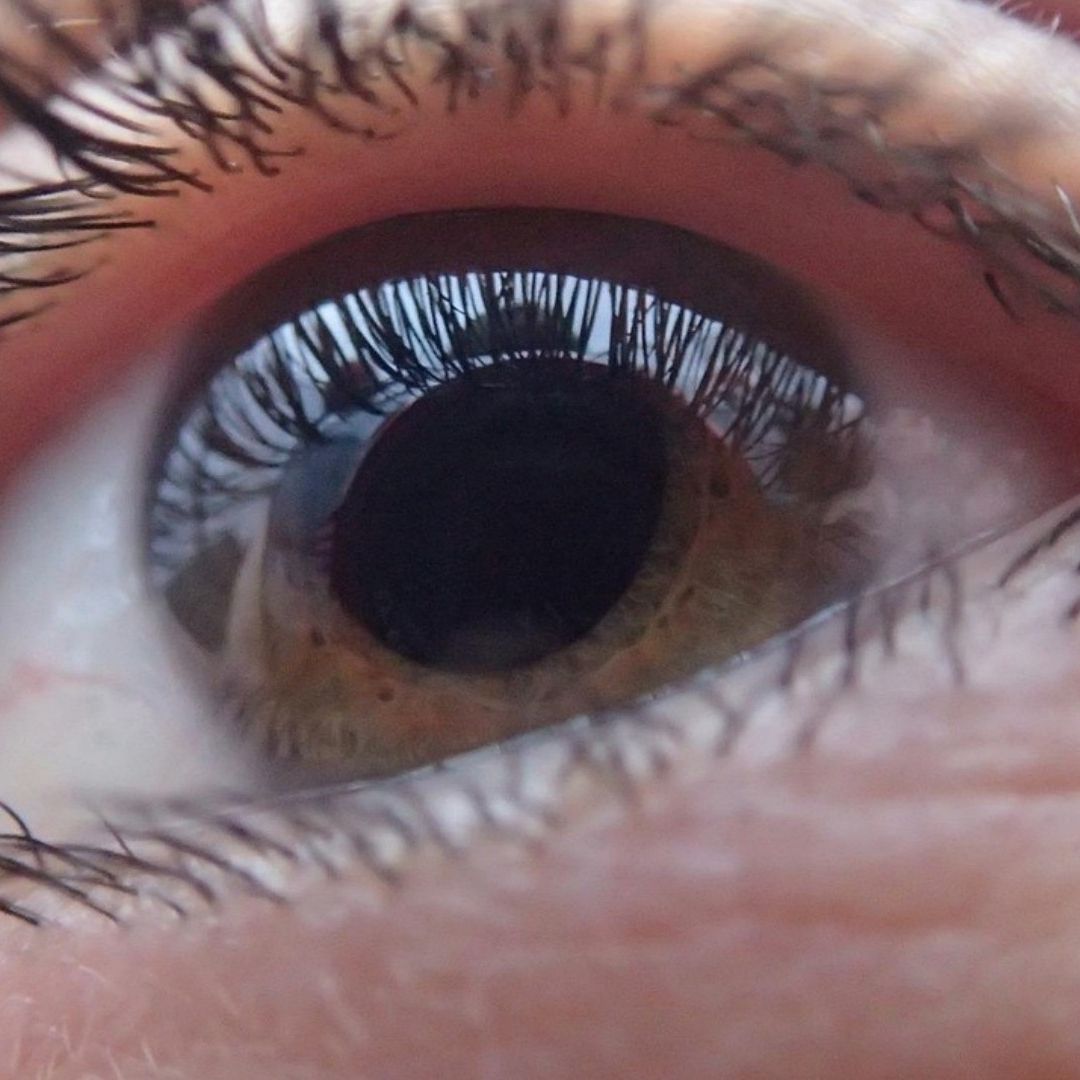 Qué es el glaucoma