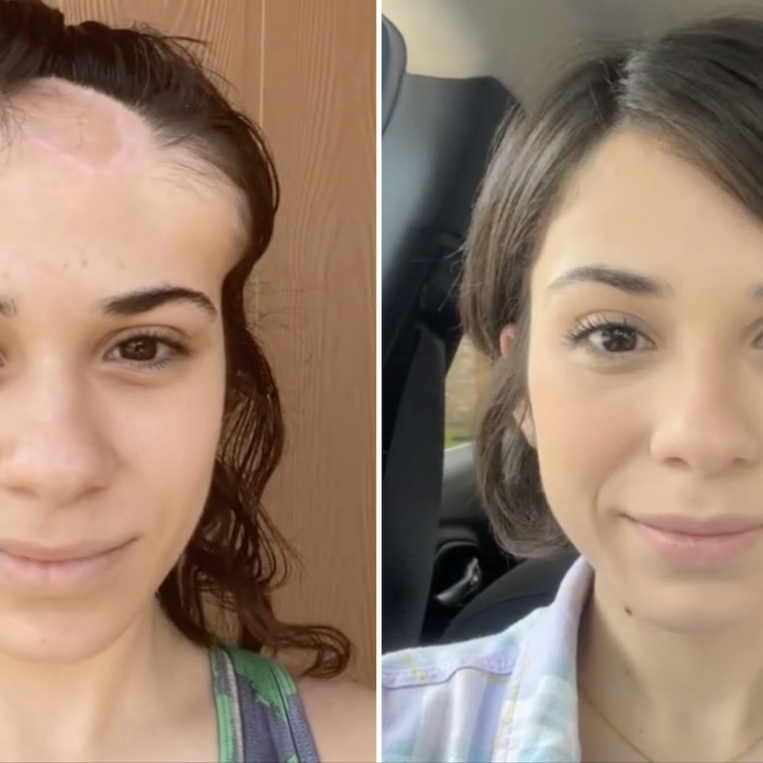 Tiktoker Alondra Sierra muestra el cambio tras cirugía contra cáncer de piel