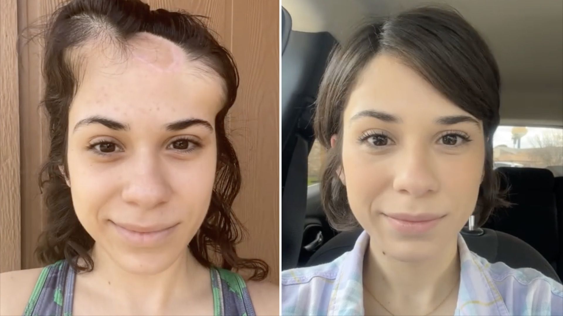 Tiktoker Alondra Sierra muestra el cambio tras cirugía contra cáncer de piel