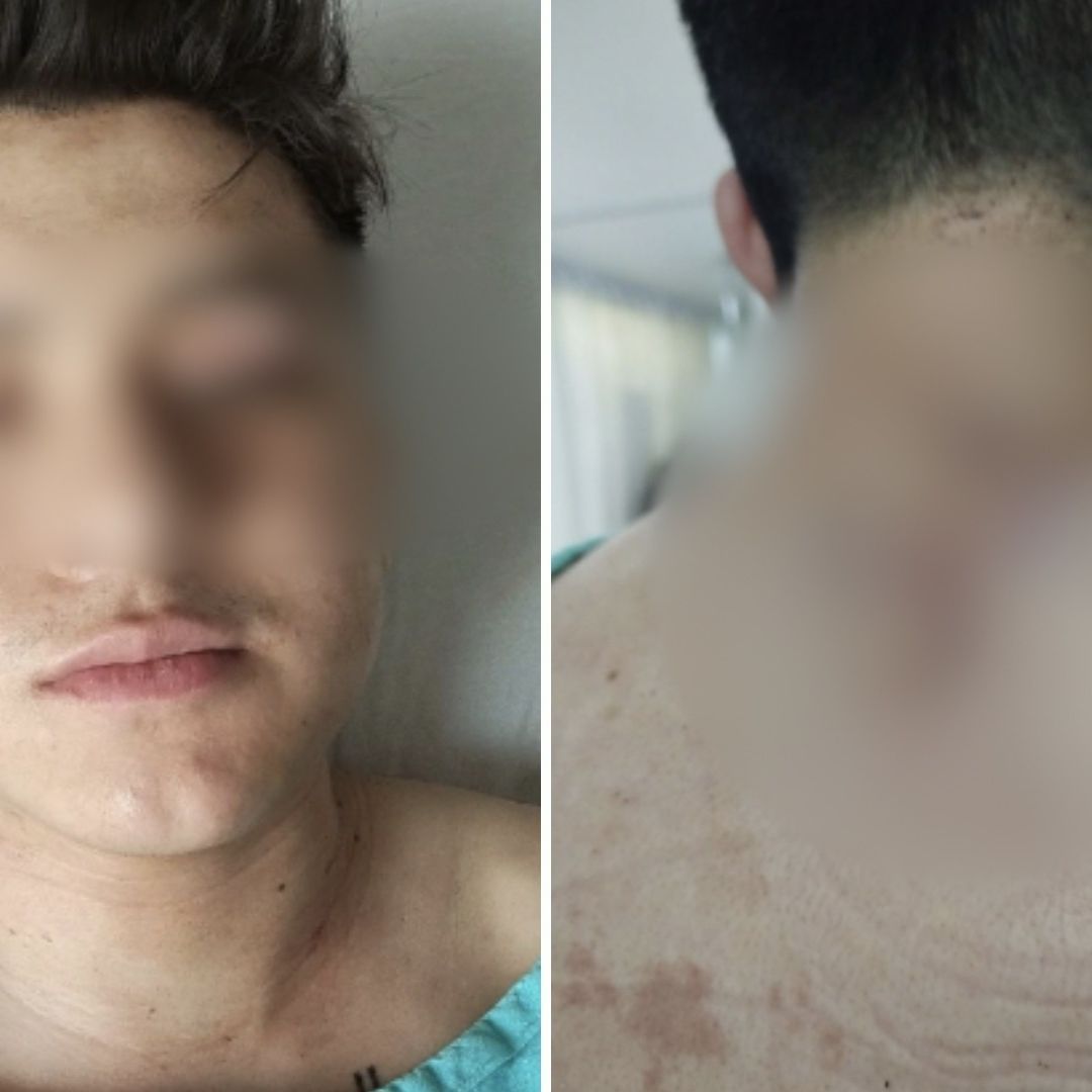 Ladrón le Entierra un Cuchillo a un Estudiante en Asalto con su Novia en el Parque Ecológico