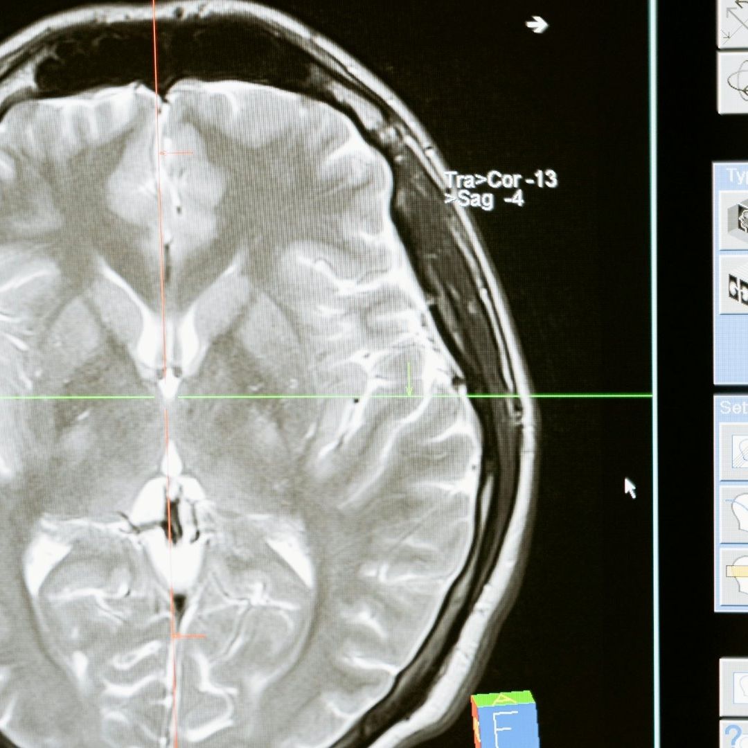 Hallan larvas en cerebro de hombre