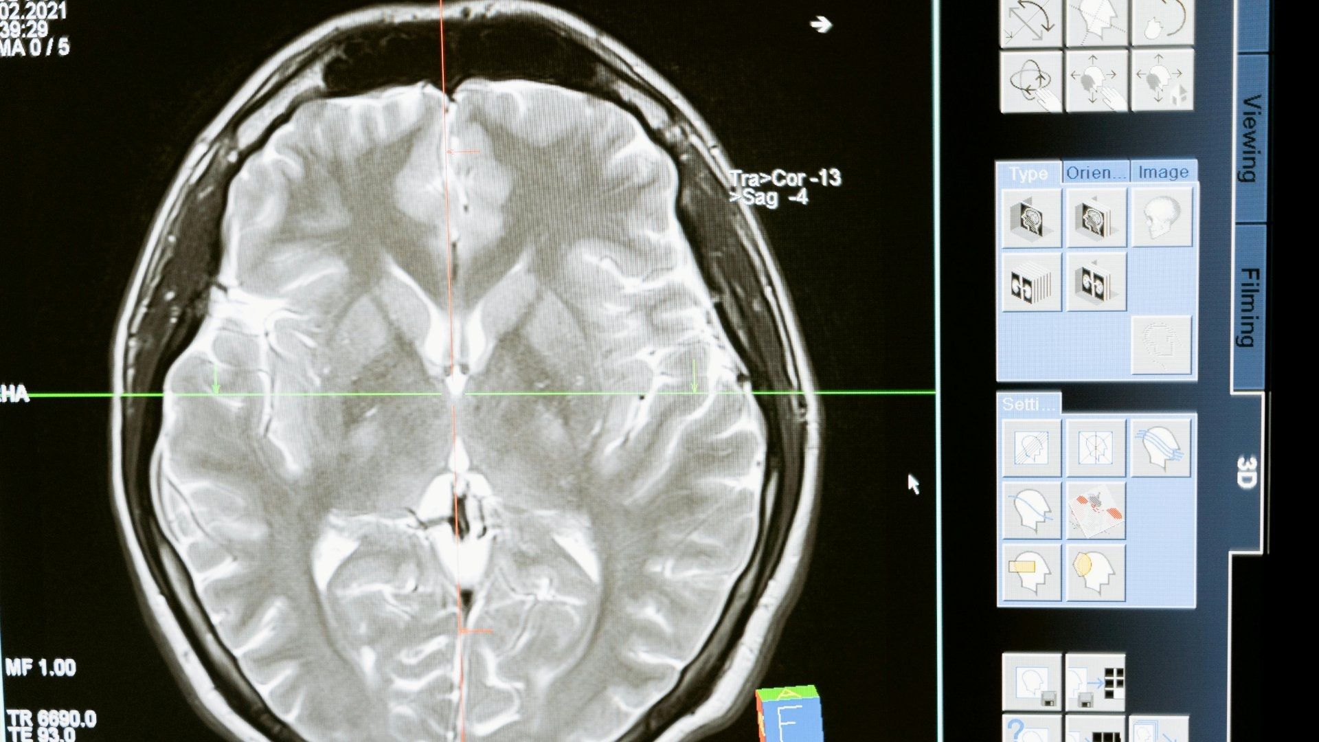 Hallan larvas en cerebro de hombre