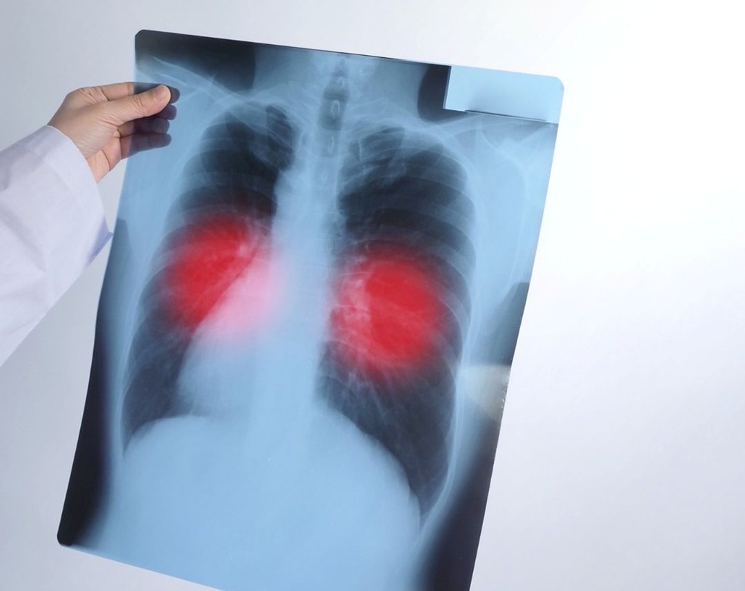 Alan Vázquez en campaña contra la tuberculosis en comunidades vulnerables