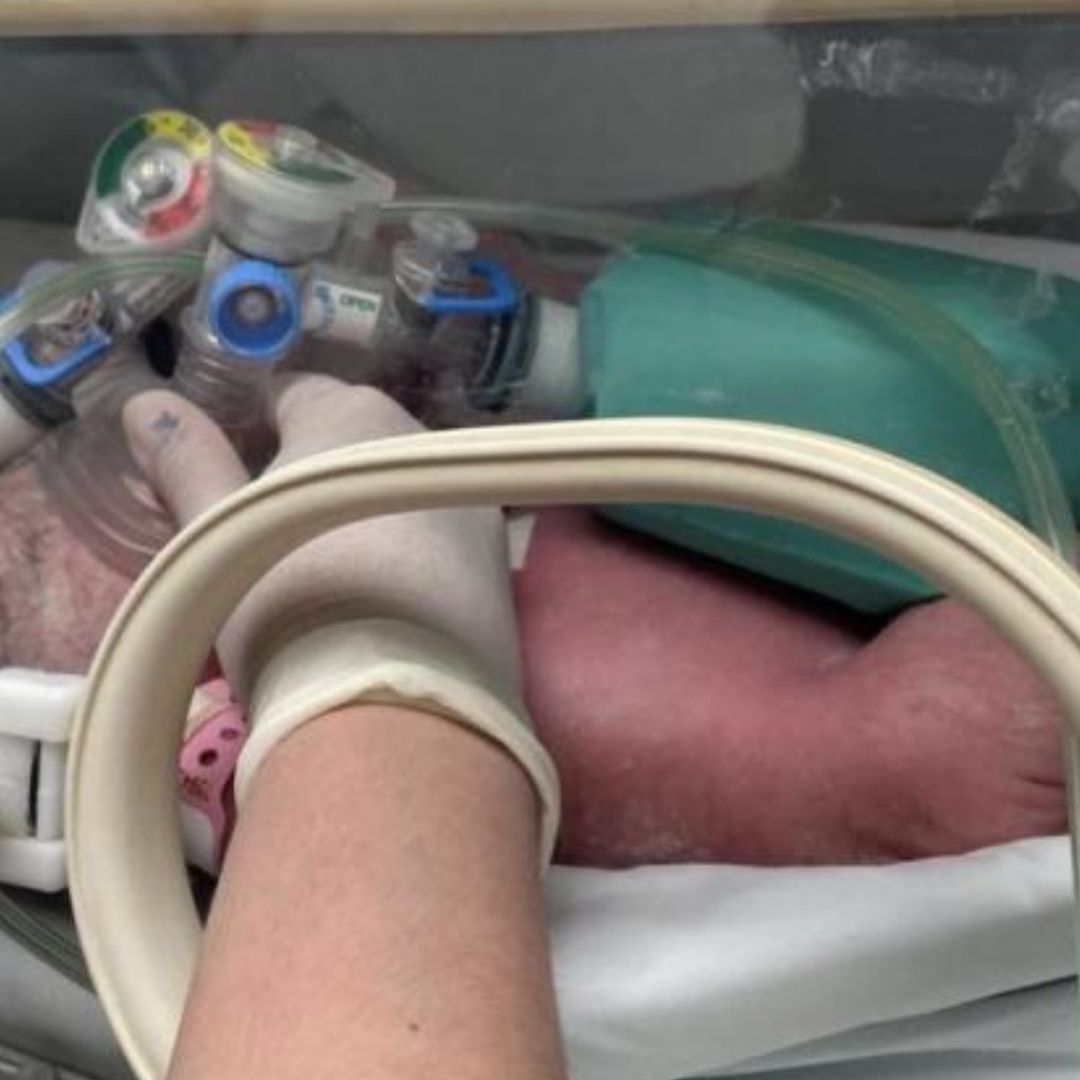 Nacen bebés unidas por el abdomen en hospital de NL