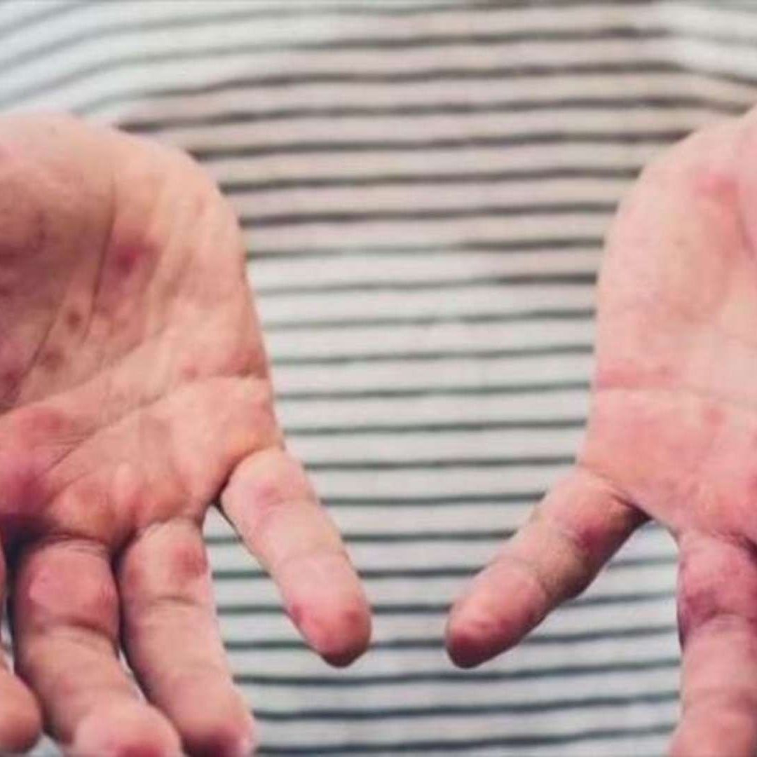 El sarampión es altamente contagioso entre la población; así se transmite de persona a persona