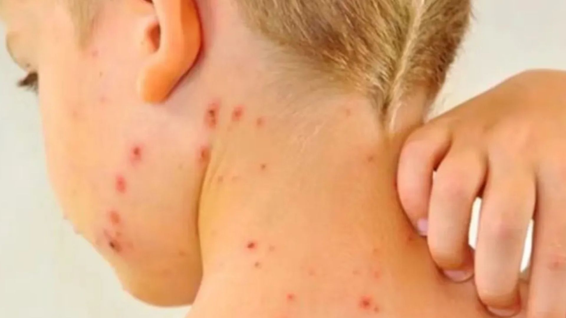 Alerta epidemiológica por sarampión en México