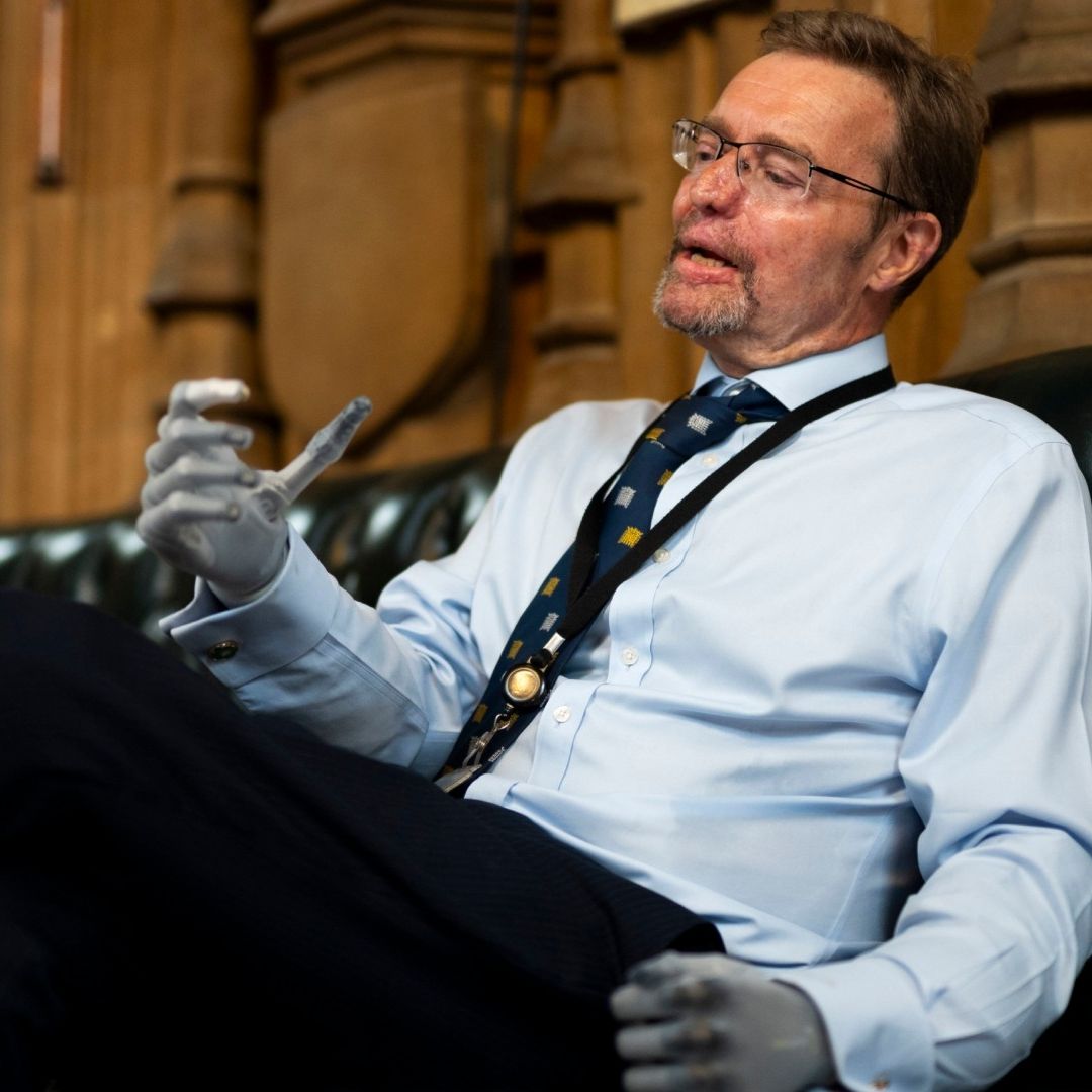 Él Es Craig Mackinlay, el Primer "Parlamentario Biónico" en Reino Unido