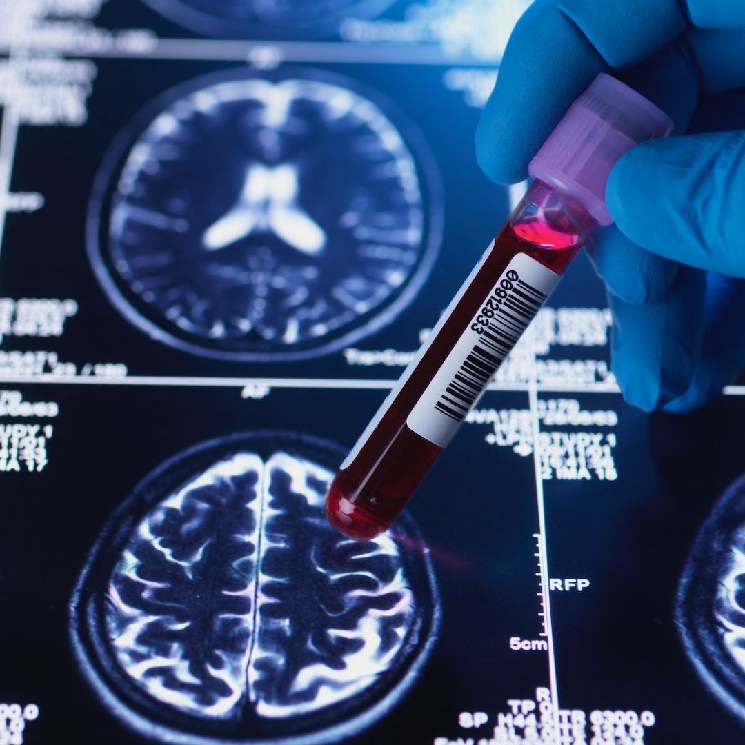 Estudio sobre la hipótesis amiloide del Alzheimer sería falso