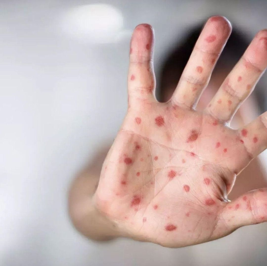 Hasta el 25 de mayo de este año, la Secretaría de Salud ha registrado 1,871 casos probables de sarampión y rubéola