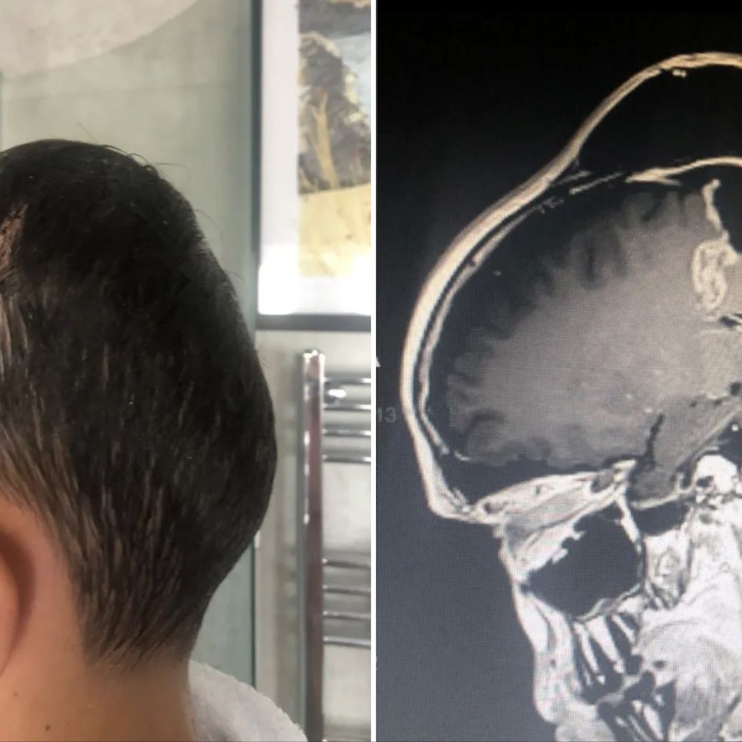 Le dijeron que usaba mucho el celular, pero tenía un tumor