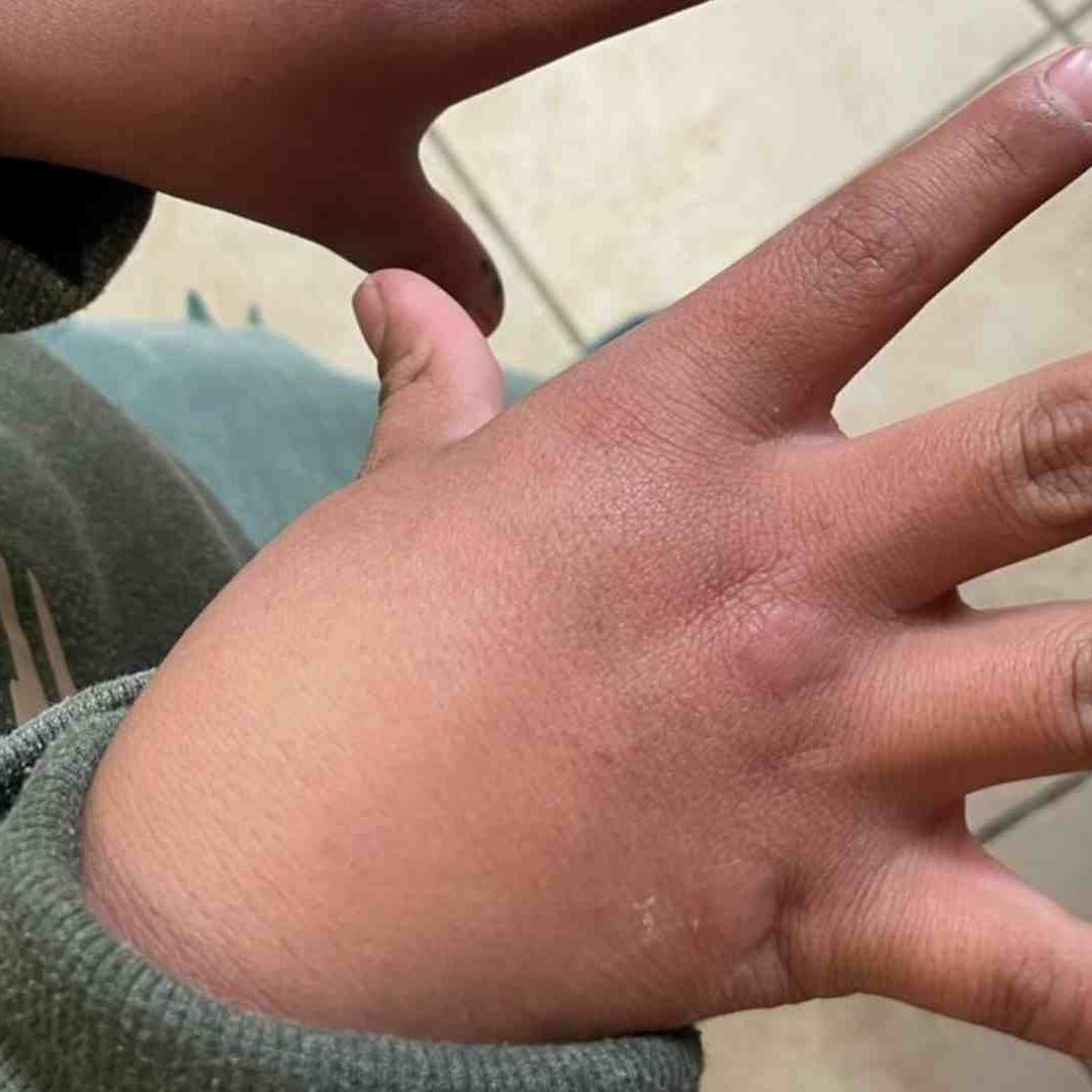Autoridades educativas confriman la suspensión de clases en dos escuelas de Tlaquilpa por presuntos casos de Coxsackie.