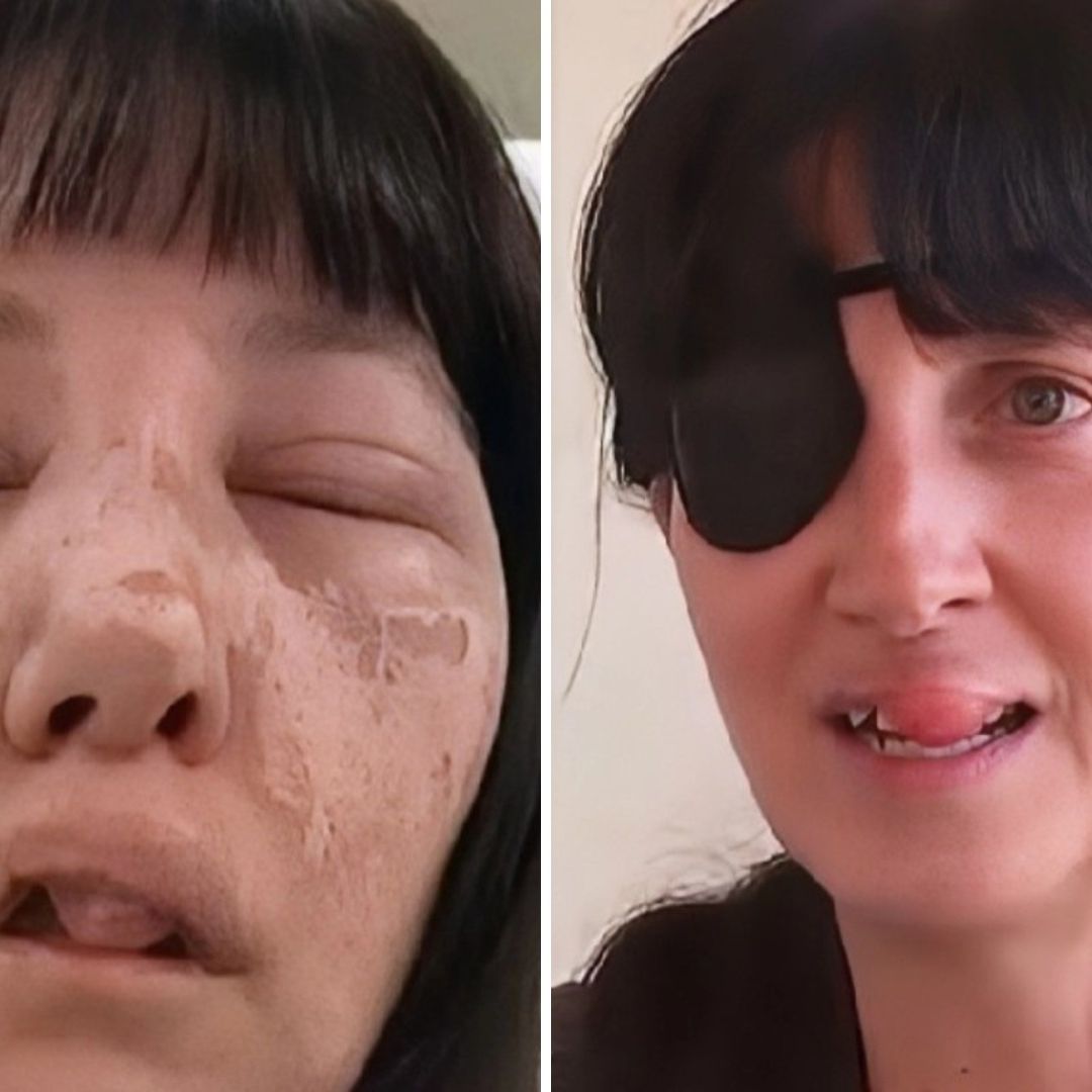 Mujer es Atacada en el Rostro por Arañas Violinistas y Sobrevive