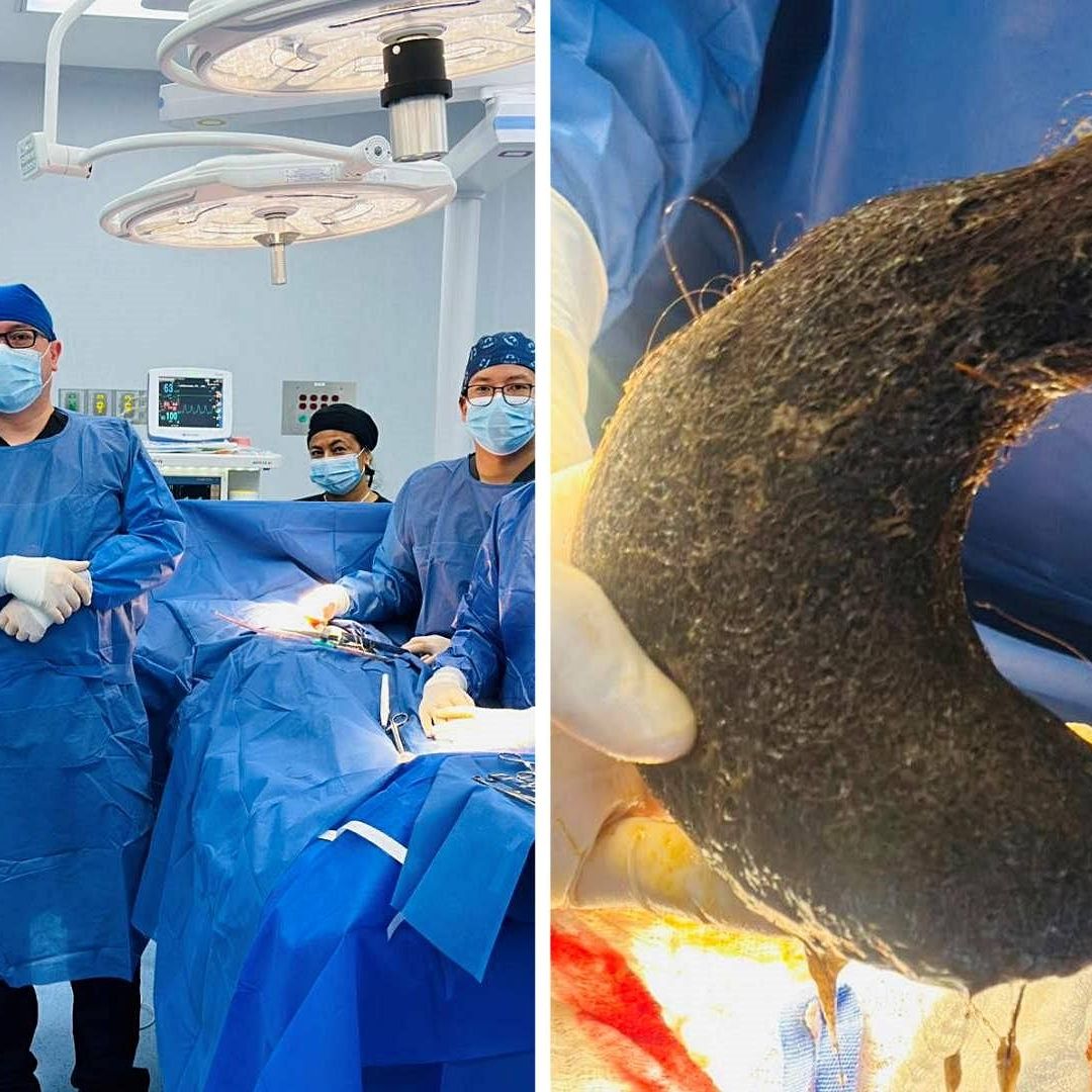 Extraen Gigantesca Bola de Cabello del Estómago de una Joven de 24 Años