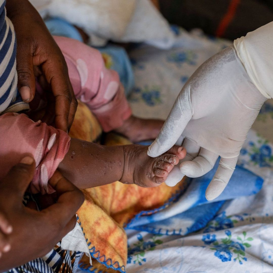 Qué es Mpox significado cuántos casos confirmados hay viruela del mono en México 2024