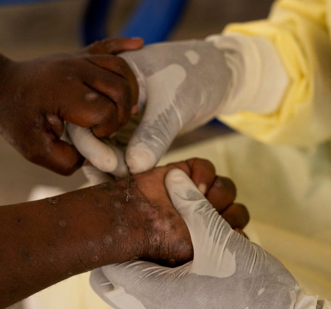 Aviso Epidemiológico en México por Mpox; Activan Protocolo en Unidades Médicas para Evitar Brote