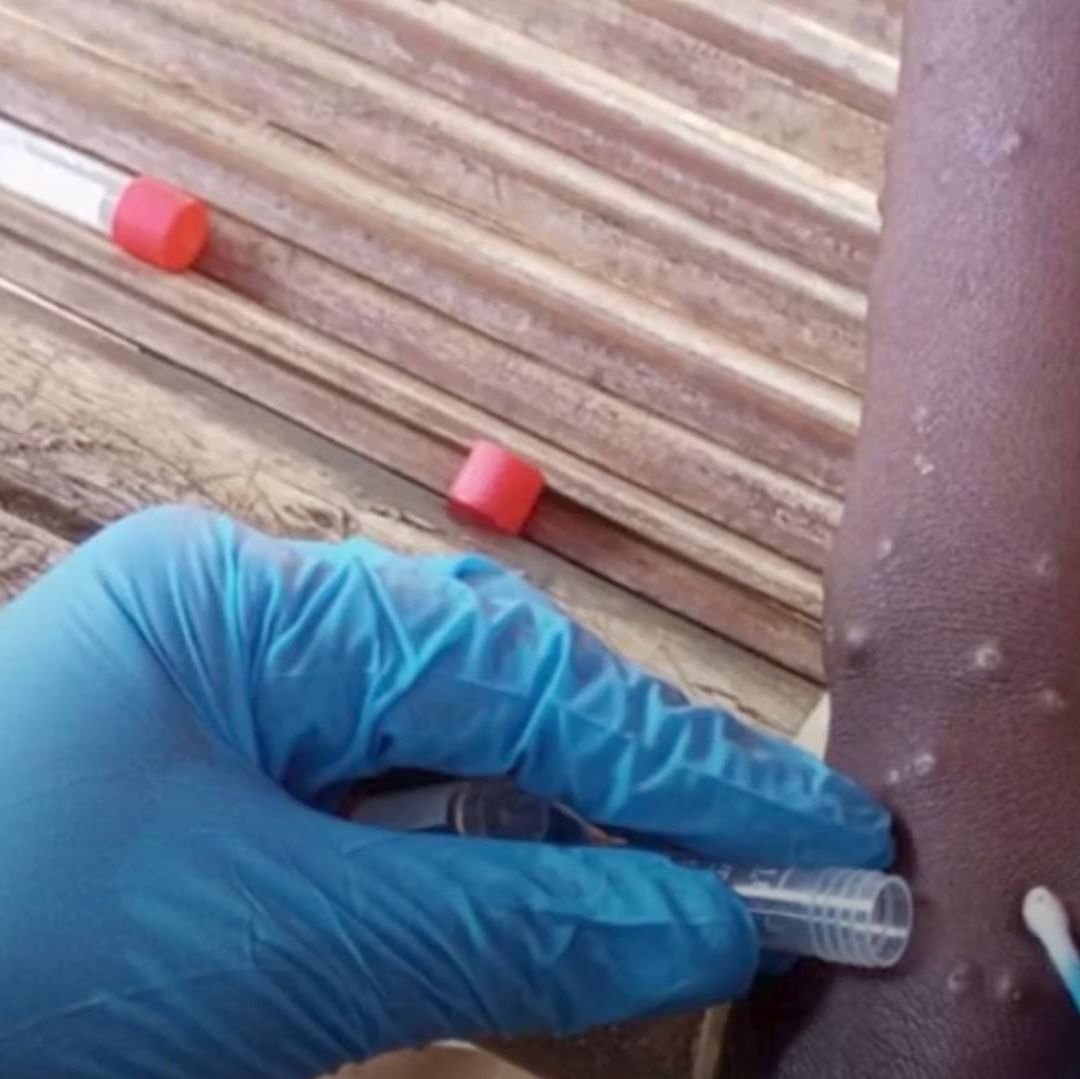 Aún No se Han presentado Casos de Viruela del Mono en Sonora