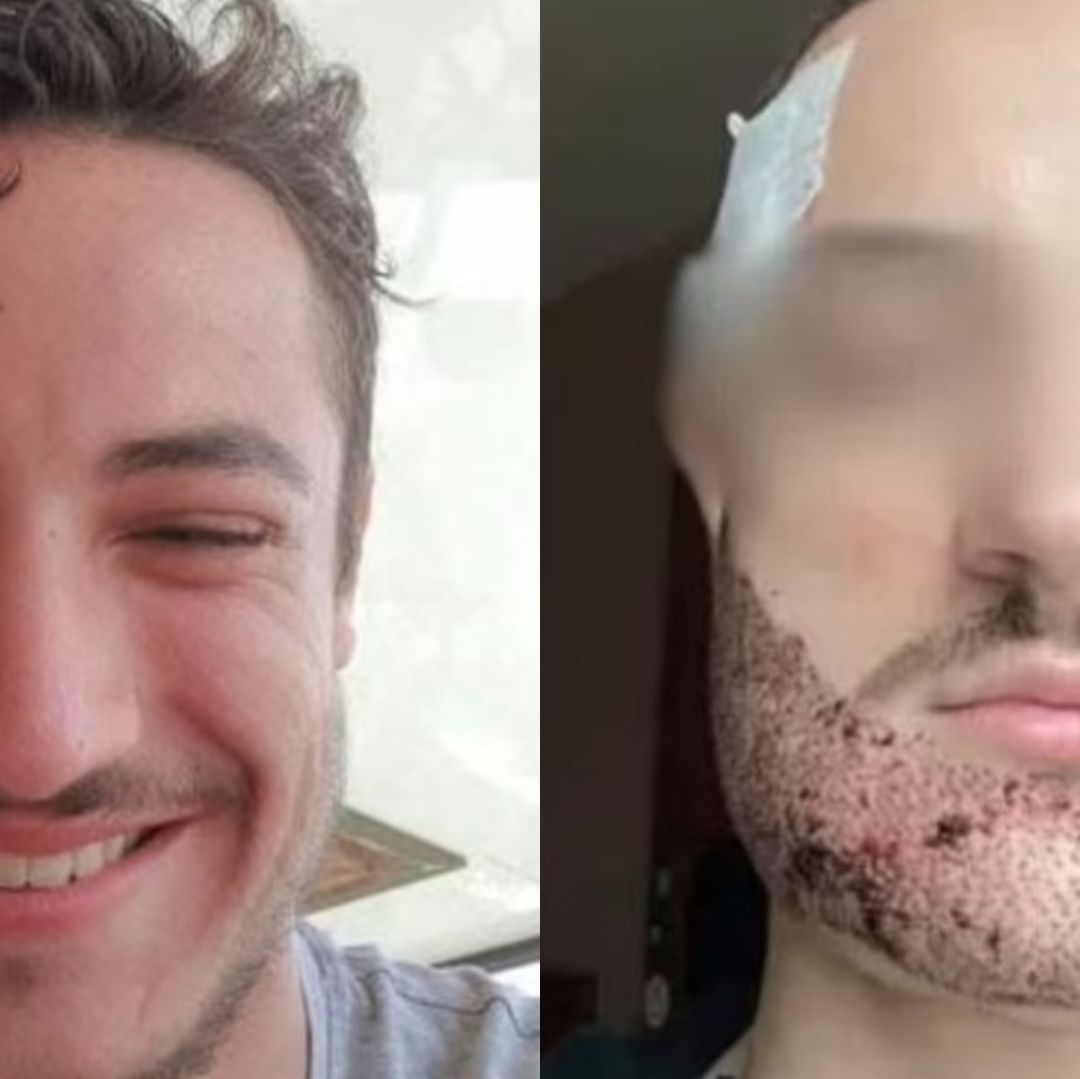 Mathieu Vigier Latour quedó traumatizado por su apariencia después de la operación. Foto Redes Sociales