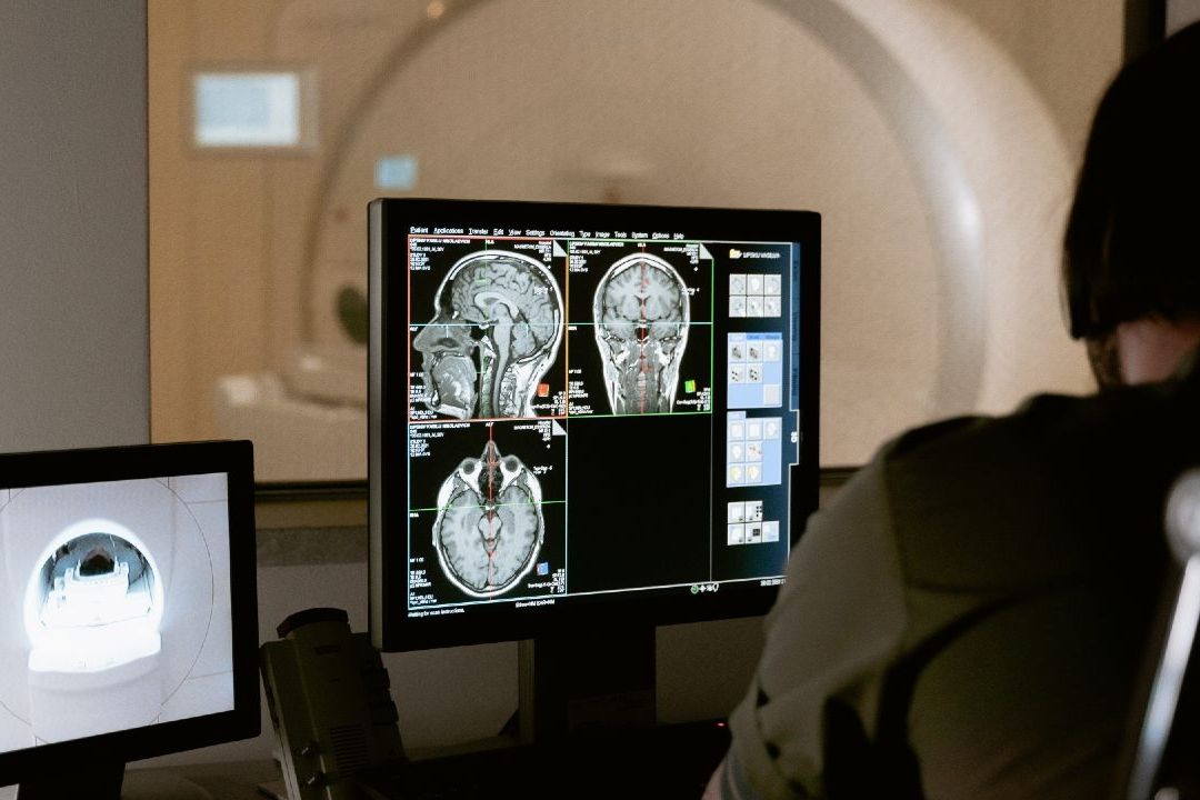 Lecanemab es el medicamento contra Alzhéimer que según un estudio reduce el cerebro