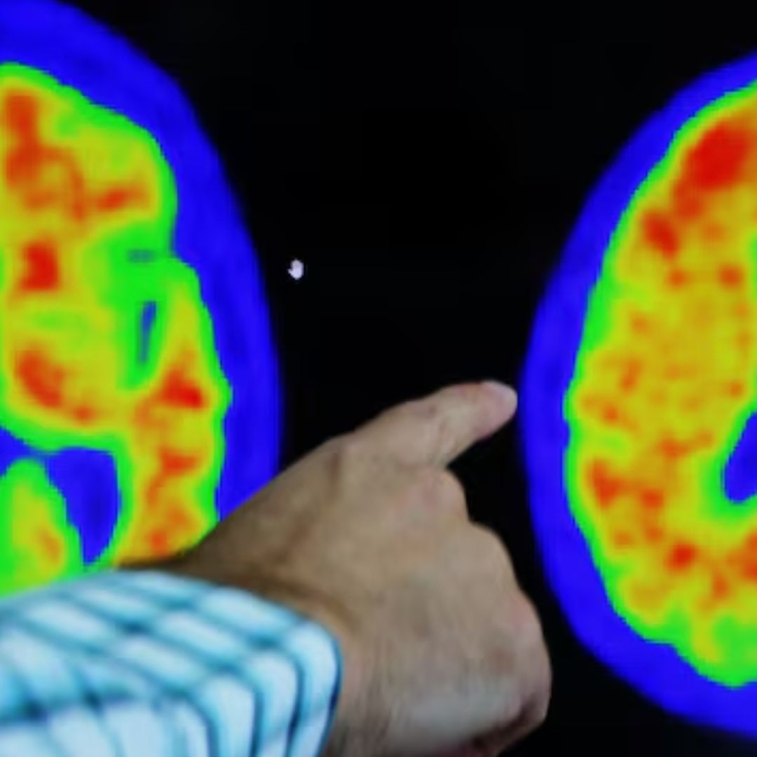 Oler Flatulencias Previene el Alzheimer y Aumenta Capacidad Cerebral, Según Nuevo Estudio
