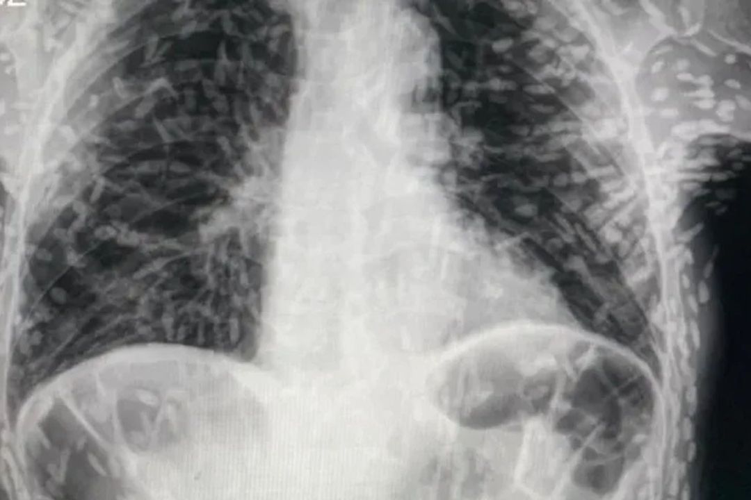 Hombre Acude por Tos al Médico y Descubre que Está Lleno de Parásitos