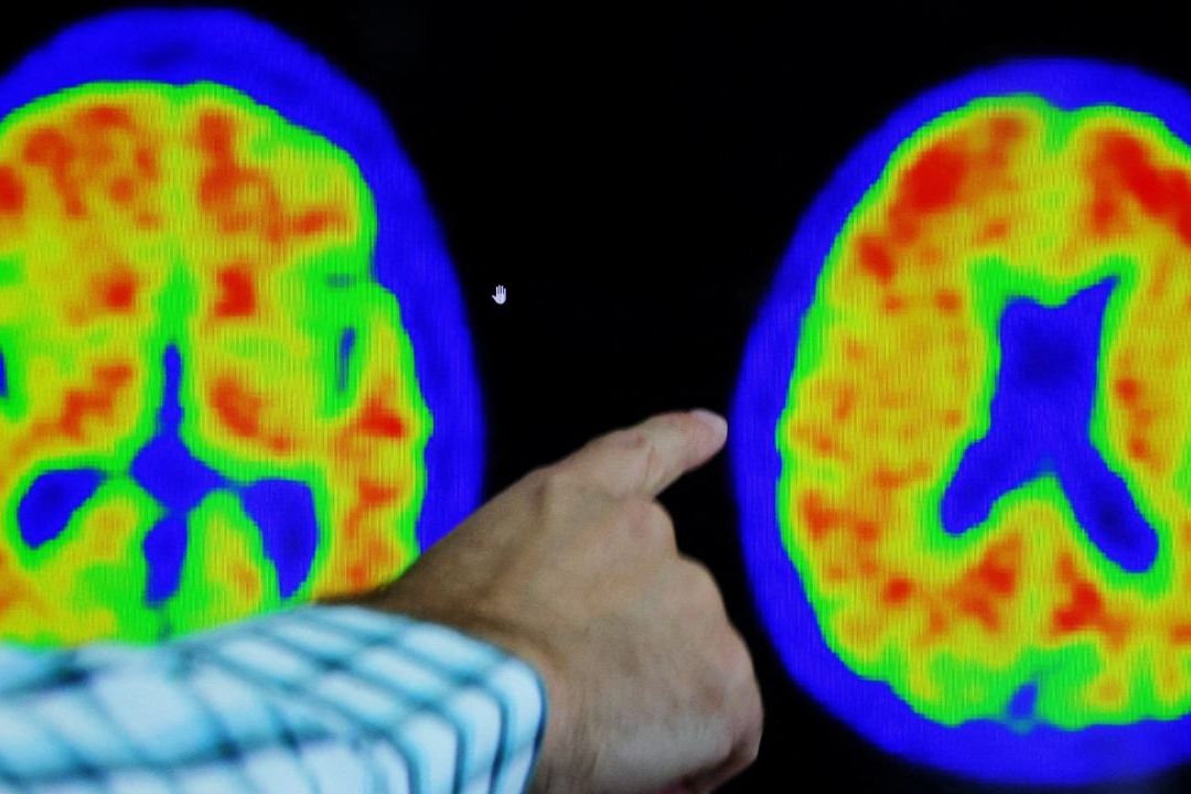 Biomarcador sanguíneo podría anticipar si un anciano sufrirá Alzheimer