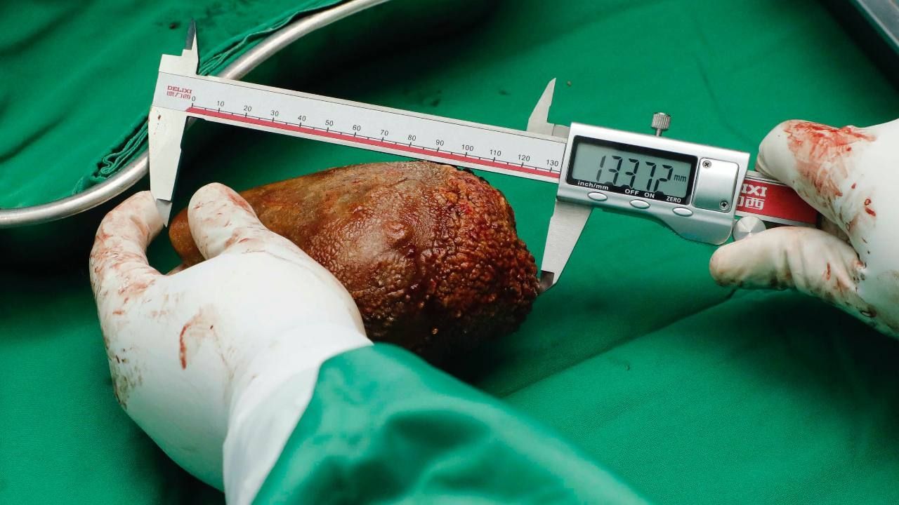 Cálculo Renal Gigante: Médicos Extirpan Piedra de Más de 800 Gramos y 13 Centrímetros