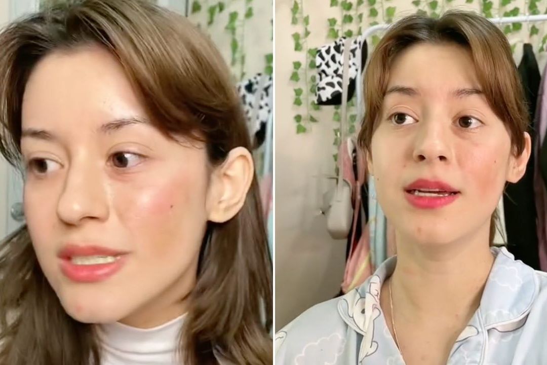 Le dijeron que su esclerodermia era ‘aesthetic’