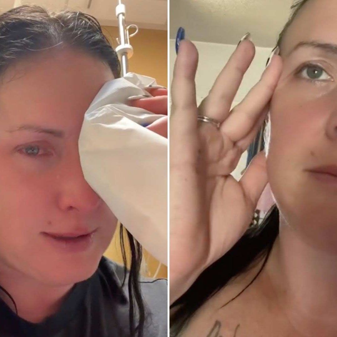 Mujer Se Aplica Pegamento en los Ojos; Pensó que Eran sus Gotas