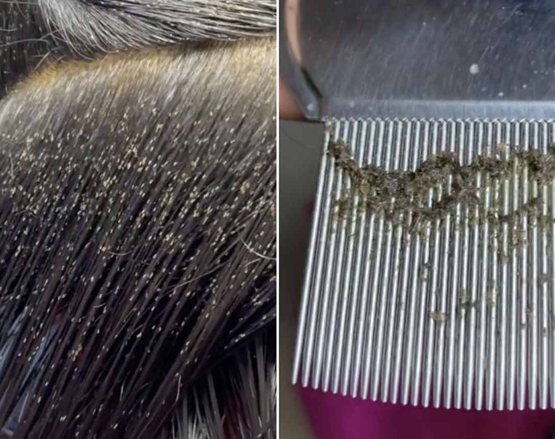 Video: Niña se Llena de Piojos, Va a Consulta y su Mamá no Paga