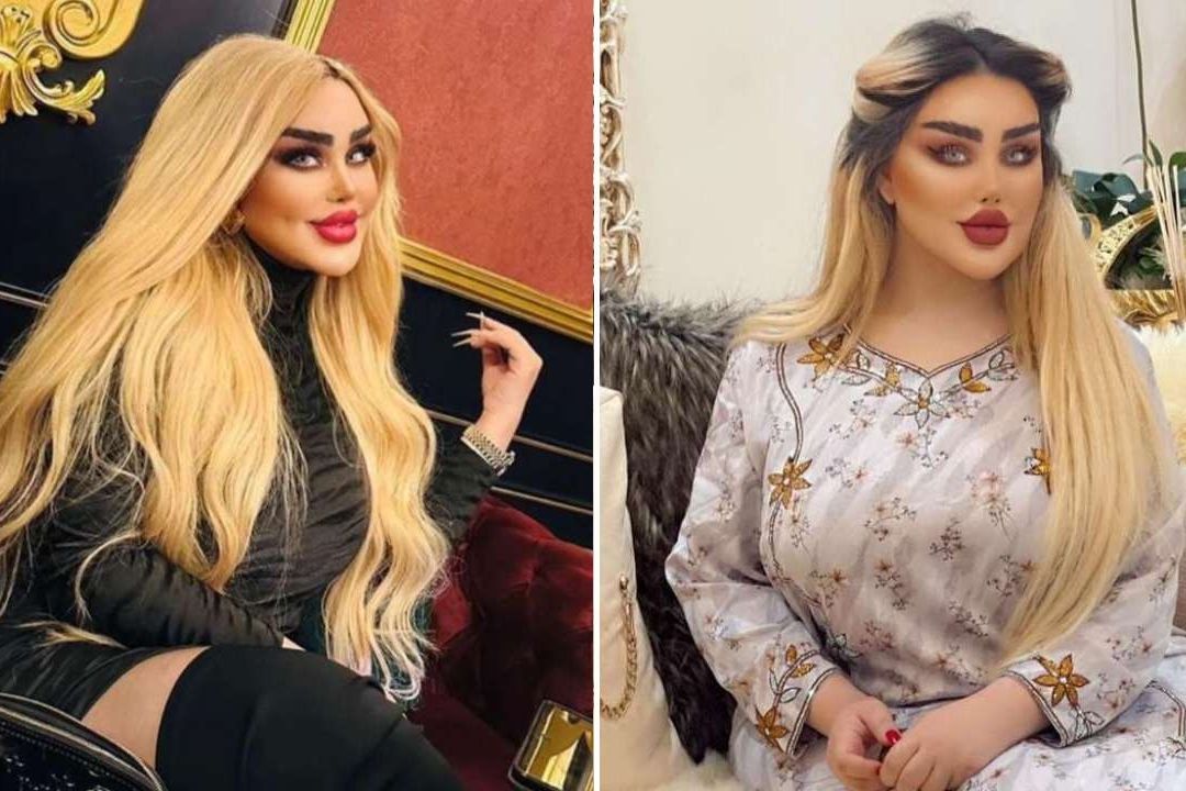 Dalia Naeem, la mujer iraquí que se hizo más de 40 cirugías para parecerse a la muñeca Barbie