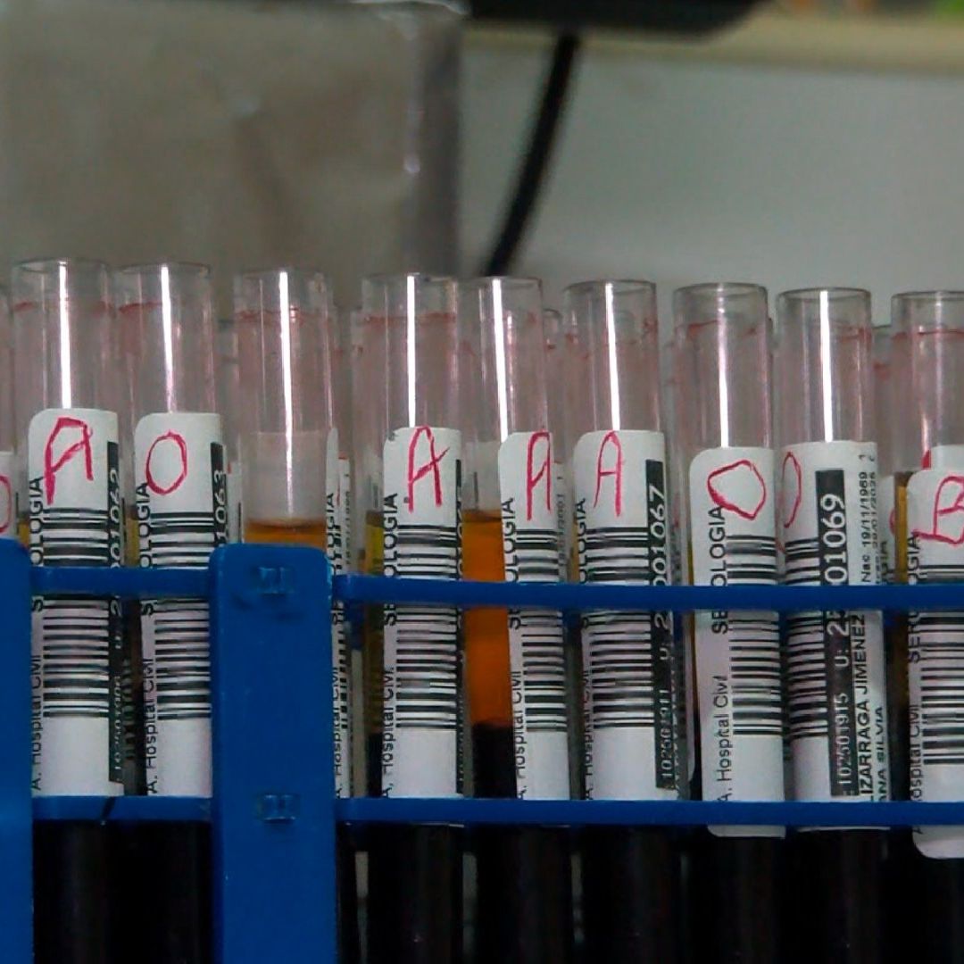 Acusan a un presunto doctor por brote de hepatitis C en Tepatitlán