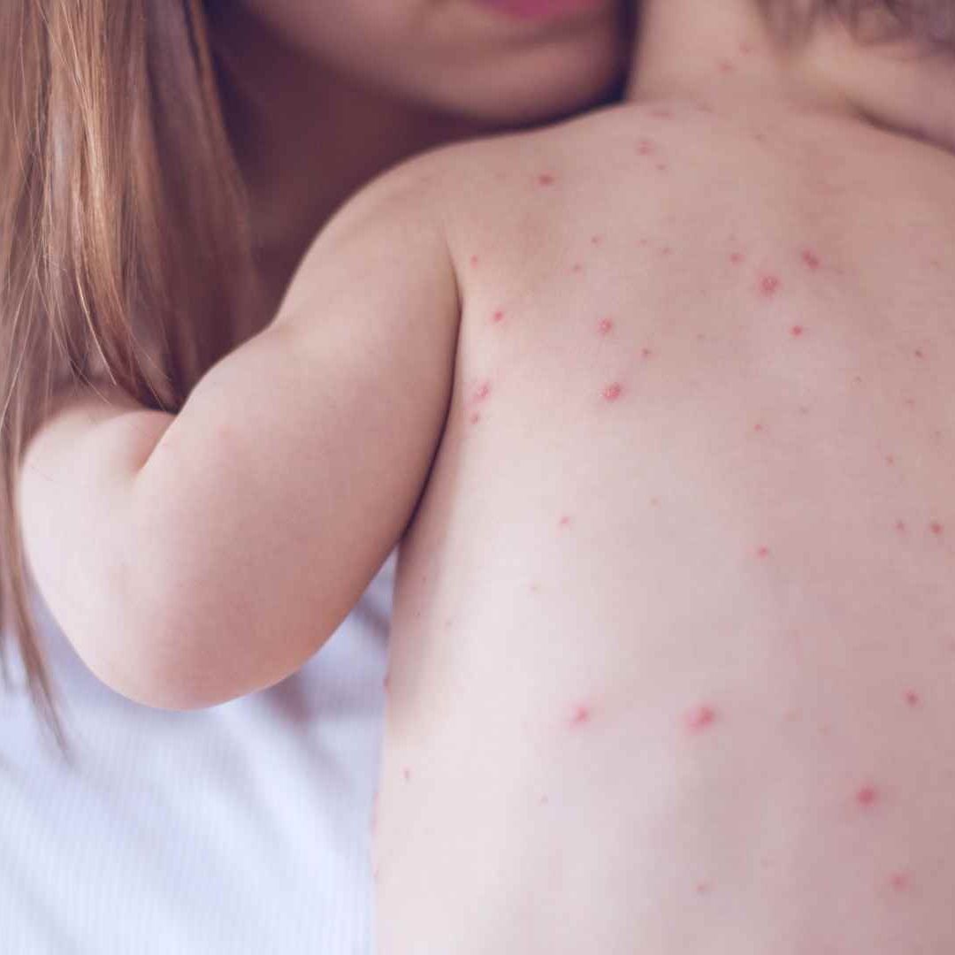 Madre e Hija se Contagian de Sarampión en Querétaro