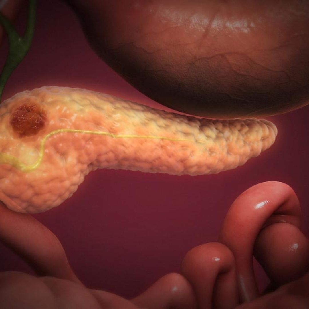 Científicos Españoles Eliminan por Completo Cáncer de Páncreas en Ratones al Combinar 3 Fármacos