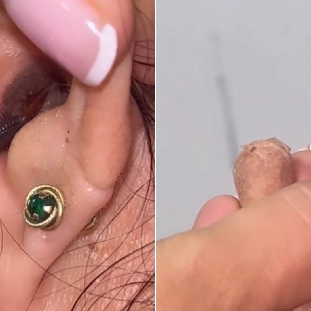 Va a Revisión Por Dolor de Oído y le Sacan una Cucaracha
