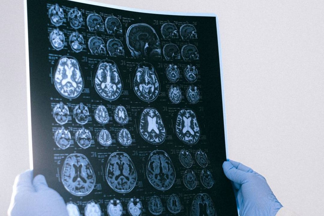 Un grupo de científicos descubrió un nuevo tipo de células del cerebro, lo que abre “inmensas perspectivas de investigación”