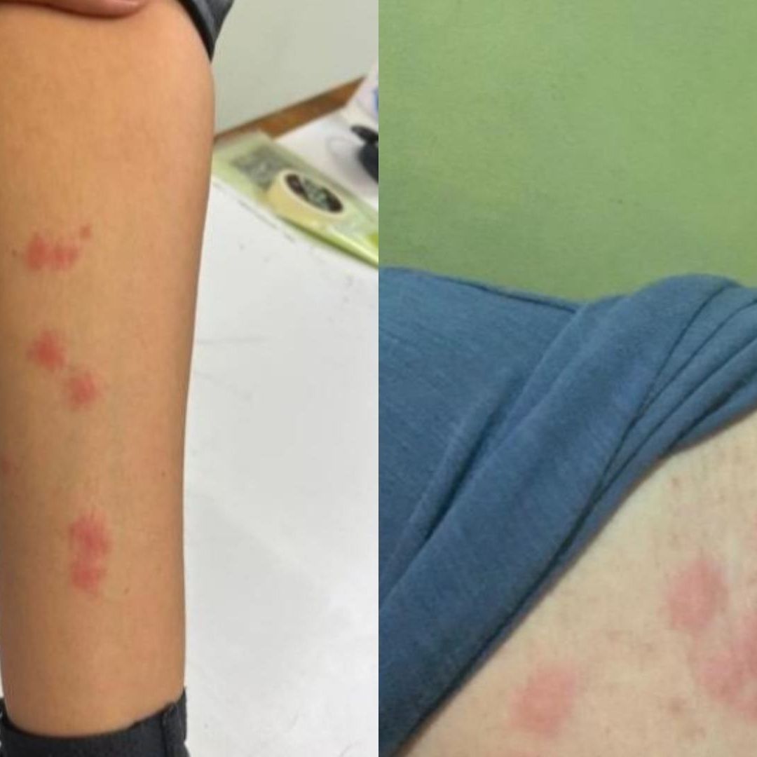 Comunidad de la Facultad de Química de la UNAM denuncia plaga de chinches en las instalaciones