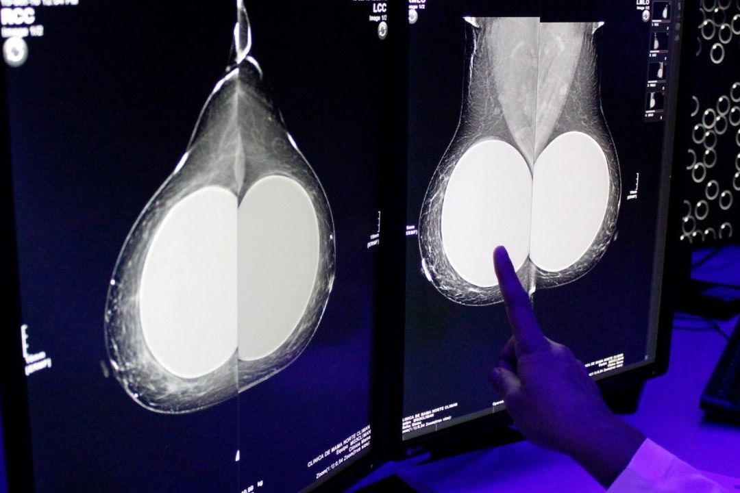 Cáncer de Mama Cobra la Vida de 2 de cada 10 Mujeres que Mueren por Tumores Malignos