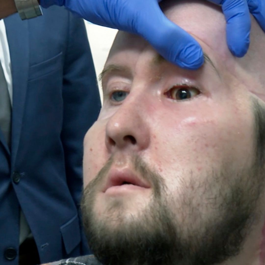 Aaron James perdió su ojo izquierdo cuando su cara tocó un cable de alta tensión. Foto: AP