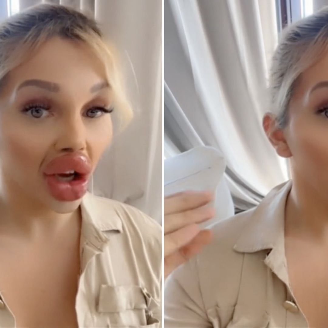 Influencer Vienna Würstel no puede comer por el tamaño de sus labios