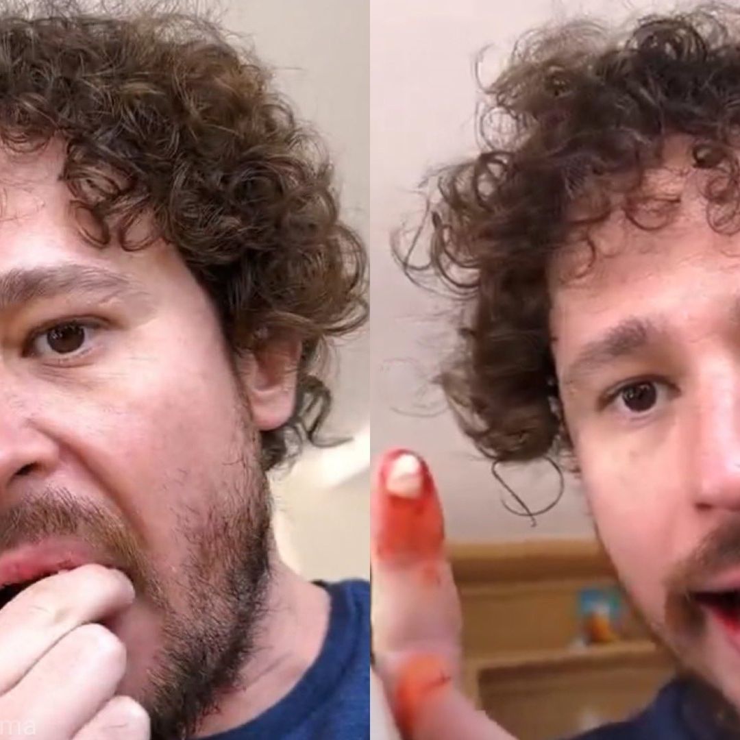 ¿La caída de dientes fue real o Luisito Comunica está próximo a inaugurar una clínica dental?