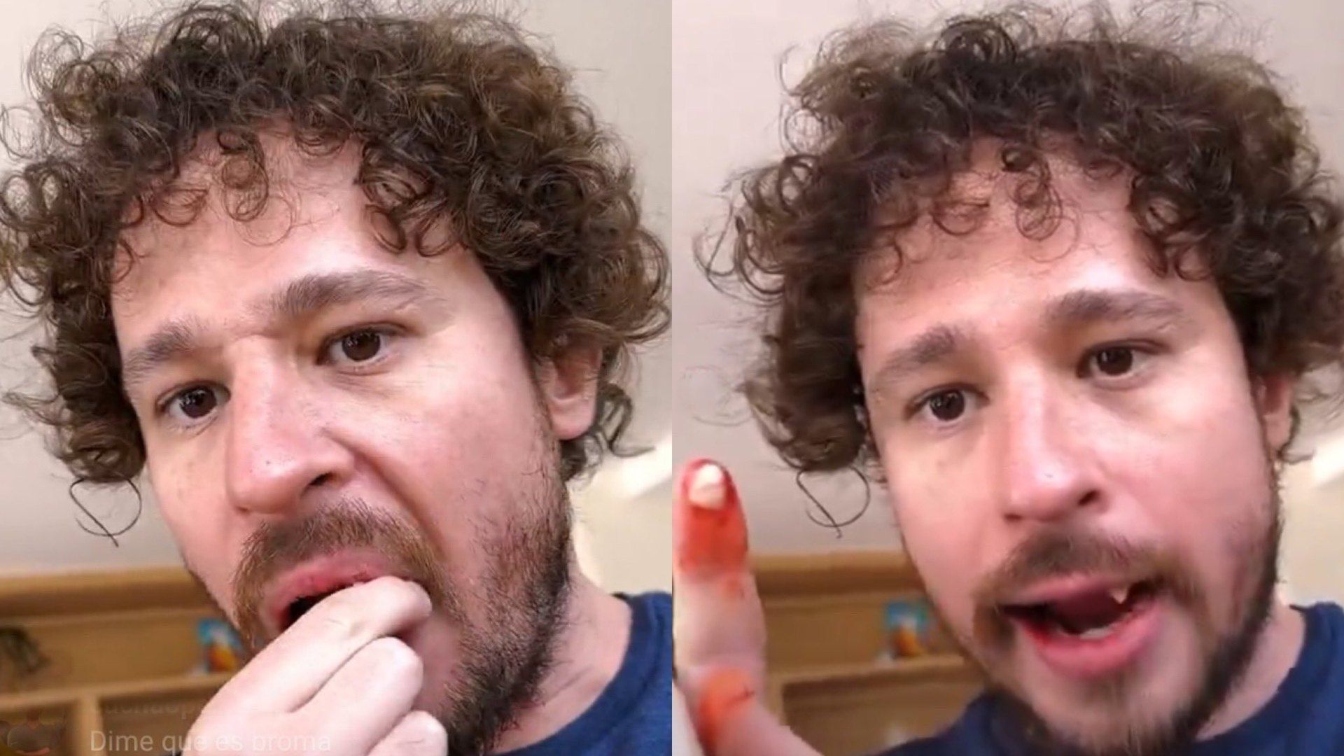 ¿La caída de dientes fue real o Luisito Comunica está próximo a inaugurar una clínica dental?