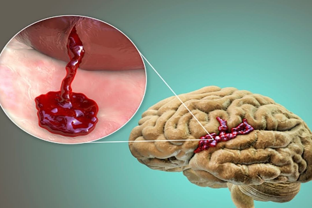 Hemorragia cerebral: ¿Qué es y cuáles son los síntomas?