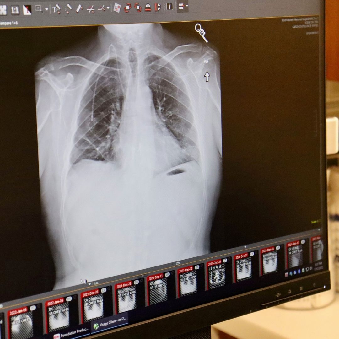 La mayoría de los casos de Cáncer de Pulmón son mortales