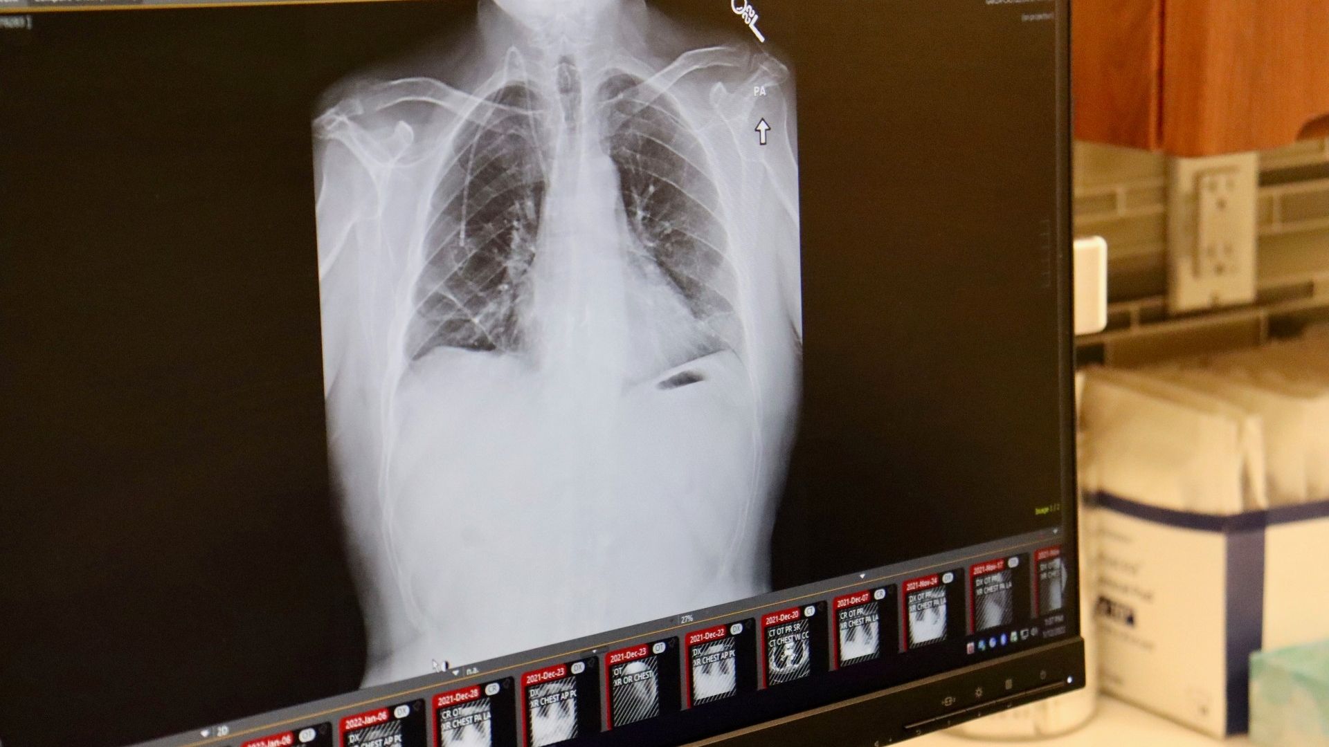 La mayoría de los casos de Cáncer de Pulmón son mortales
